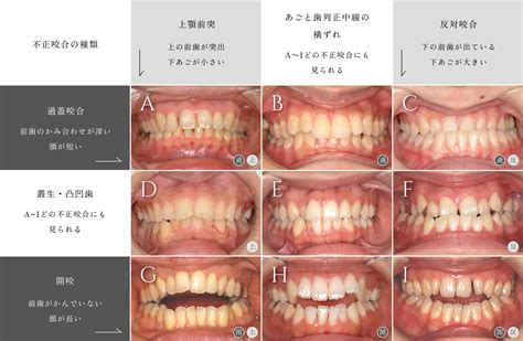 方形矯正線作用|不正咬合の原因と矯正治療